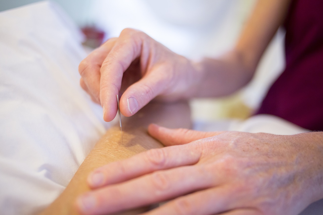 acupuncture-5126777_1280